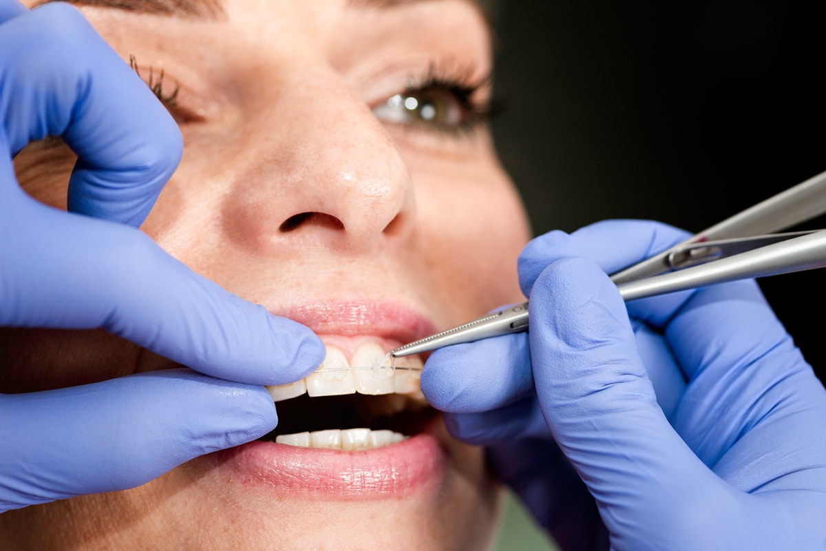 Braces for adults what to expect during the first few weeks blog
