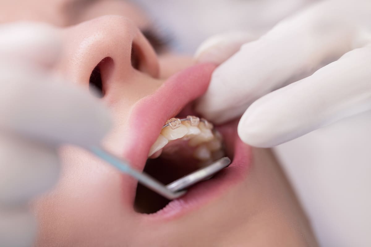 Can early orthodontic treatment reduce the need for braces later blog