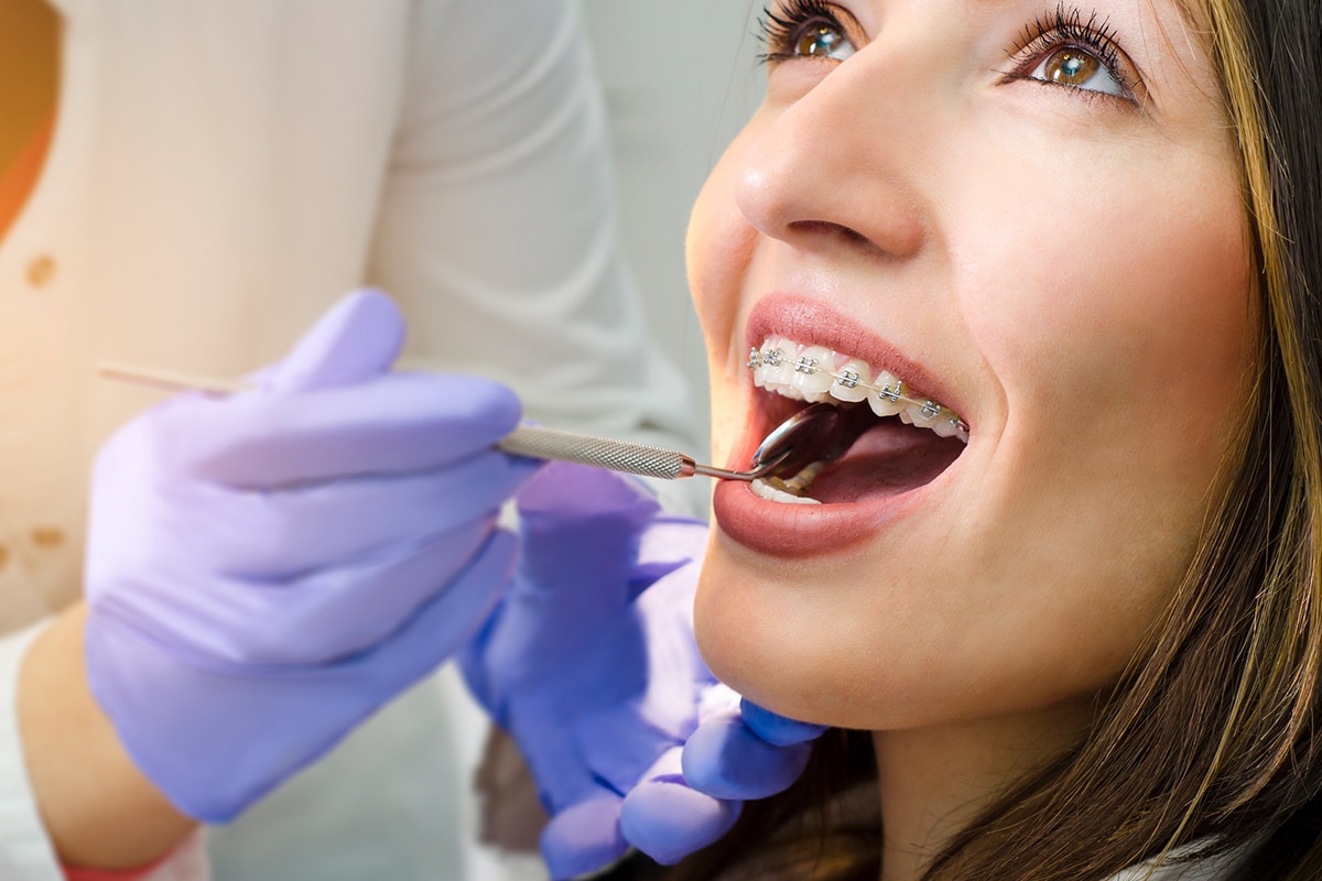 Can you get braces on just your bottom teeth blog