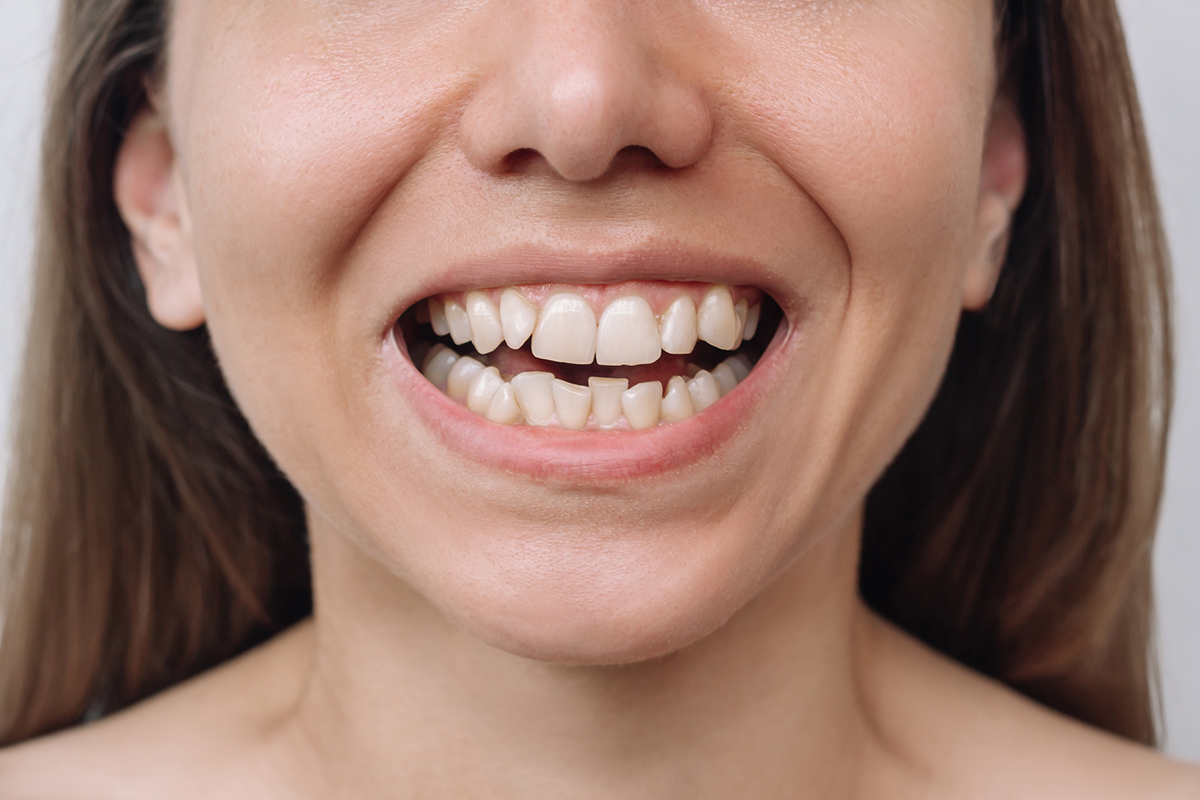 How do braces work to fix crooked teeth a simple guide for canton mi residents blog