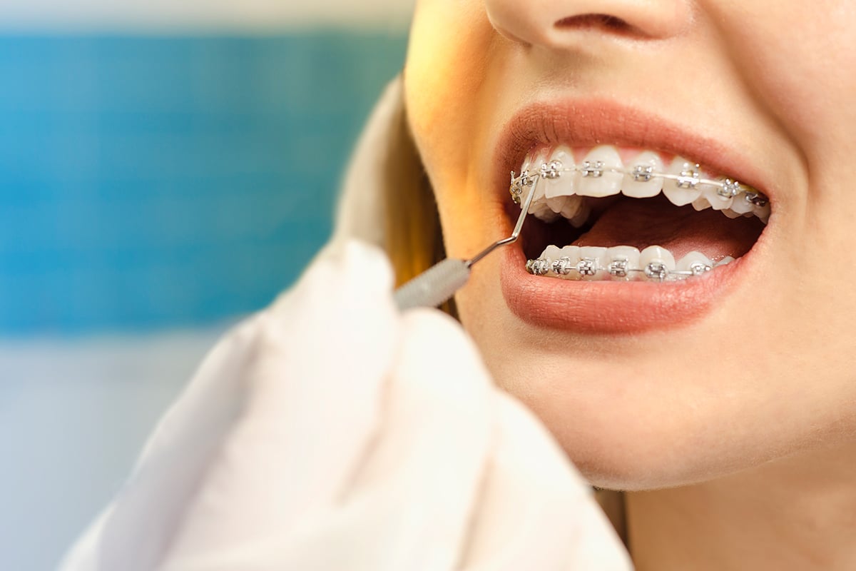 The pros and cons of metal braces vs ceramic braces in canton mi blog