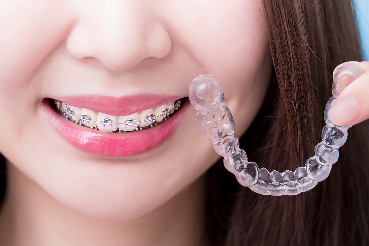 Whats the best braces option for your lifestyle blog